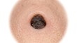 © xu - Extreme close-up of a dark, crusty mole, skin lesion, or potential melanoma on human skin indicating skin cancer risk.