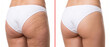 © Olga Ко - Before and after cellulite treatment comparison. Close-up of female buttocks and thighs in white underwear showing orange peel skin versus smooth firm skin. Beauty, healthcare and cosmetology concep.