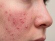 © Sanda - Papulopustular Rosacea Central Facial Redness with Papules on Adult Cheek, Chronic Inflammatory Facial Skin Disease Close Up Image