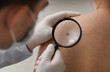 © Aamir - Dermatologist examining mole on patient shoulder with magnifying glass, representing skin cancer screening, melanoma checkup, dermatology consultation, preventive healthcare, medical diagnosis,