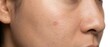 © dewi - Close up of human skin texture showing pores and minor imperfections