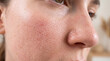 © Lerson - Close up macro view of skin texture showing pores and natural facial details with soft lighting and warm tones