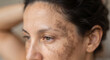© ANTOR - Woman with Melasma: A close-up portrait of a woman's face showing hyperpigmentation, likely melasma, on her cheek and forehead, hinting at concerns about skin health and beauty.