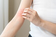 © KMPZZZ - Dermatology asian young woman, girl allergy, allergic reaction from atopic, insect bites on her arm, hand in scratching itchy, itch red spot or rash of skin. Healthcare, treatment of beauty.