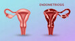 © Mirivox - Uterus and ovary comparison, healthy vs. endometriosis, illustrating tissue growth, symbolizing disease and health contrast, medical illustration