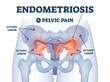 © Human Anatomy - Endometriosis ectopic lesions causing pelvic pain illustration isolated on white background