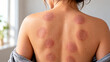 © Irina - Woman with cupping therapy marks on her back in a bright room