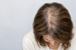 © Supakul - Overhead view of a woman with thinning hair around the crown