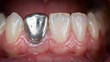 © Sabir - Close up view of human teeth showing a single metal crown on a lower incisor tooth in an open mouth with incisor surrounded healthy
