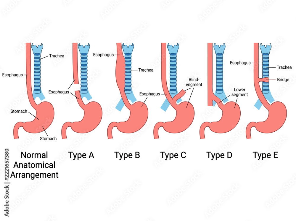 Stock-Vektorgrafik „Esophageal Atresia and Tracheoesophageal Fistula ...