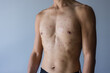 © leungchopan - Close up of adult man upper body with skin irritation