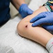 © Mihirantha - Close-Up of an Eschar Skin Lesion on a Child’s Leg Associated with Suspected Scrub Typhus Infection