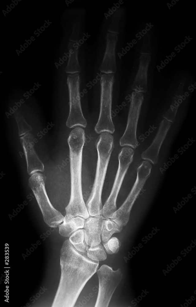 bones of the hand bones of the hand