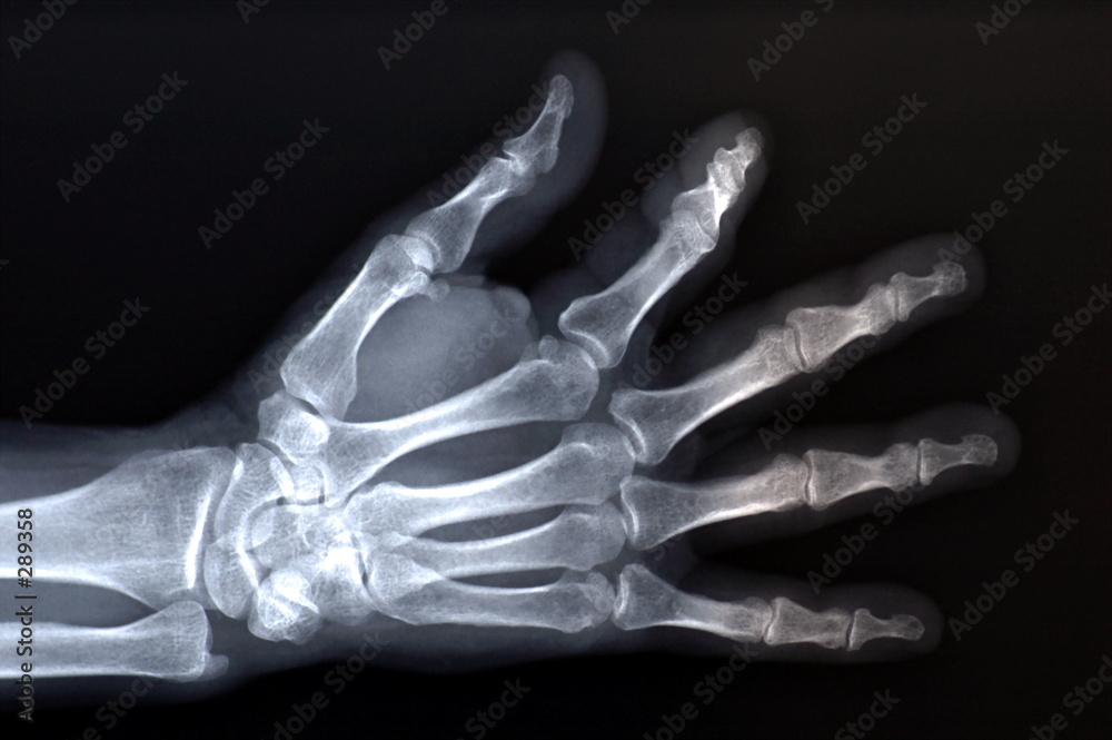 x ray x ray