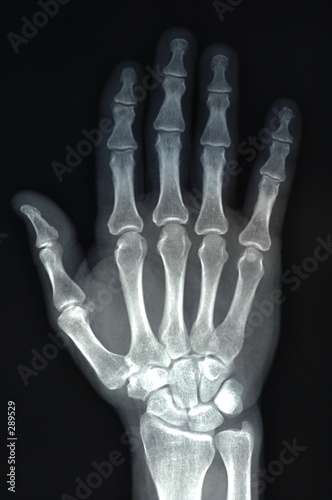x-ray of hand