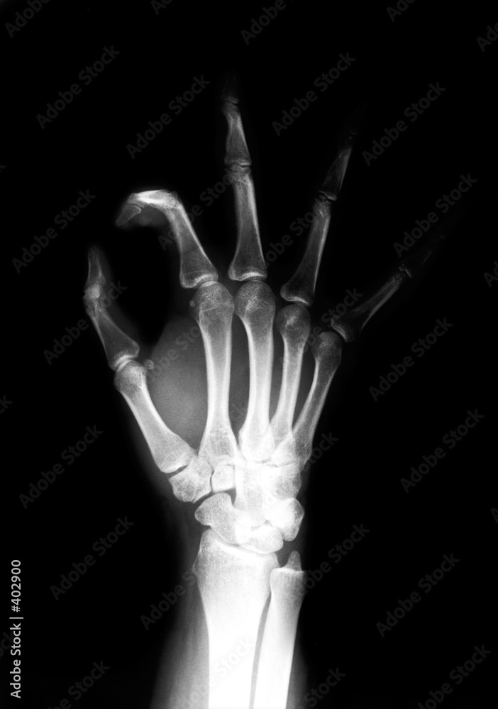 hand radiograph hand radiograph