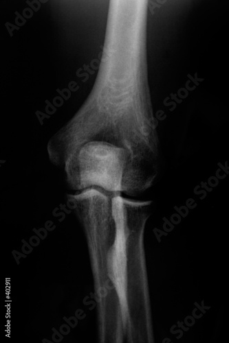 knee bones photo