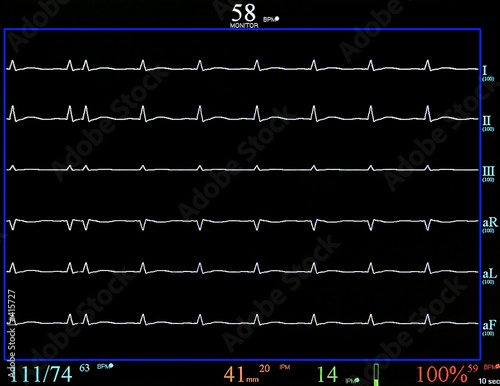 heart monitor