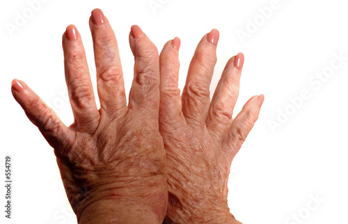 arthritic hands photo