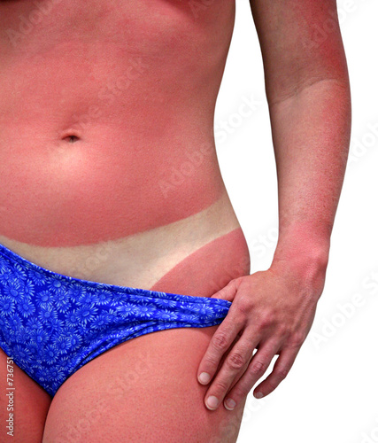 woman with bad sunburn - isolated