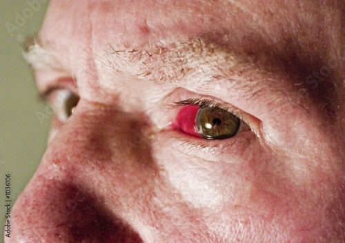 red eye