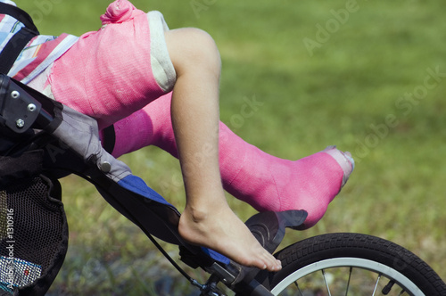 broken leg