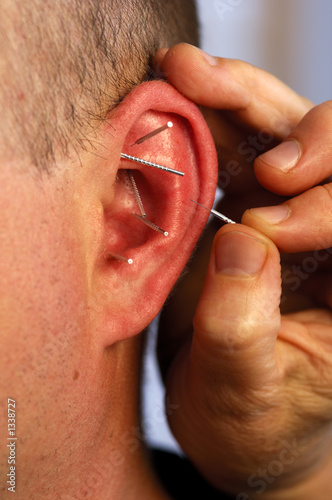 acupunturist needling acupoints in ear photo