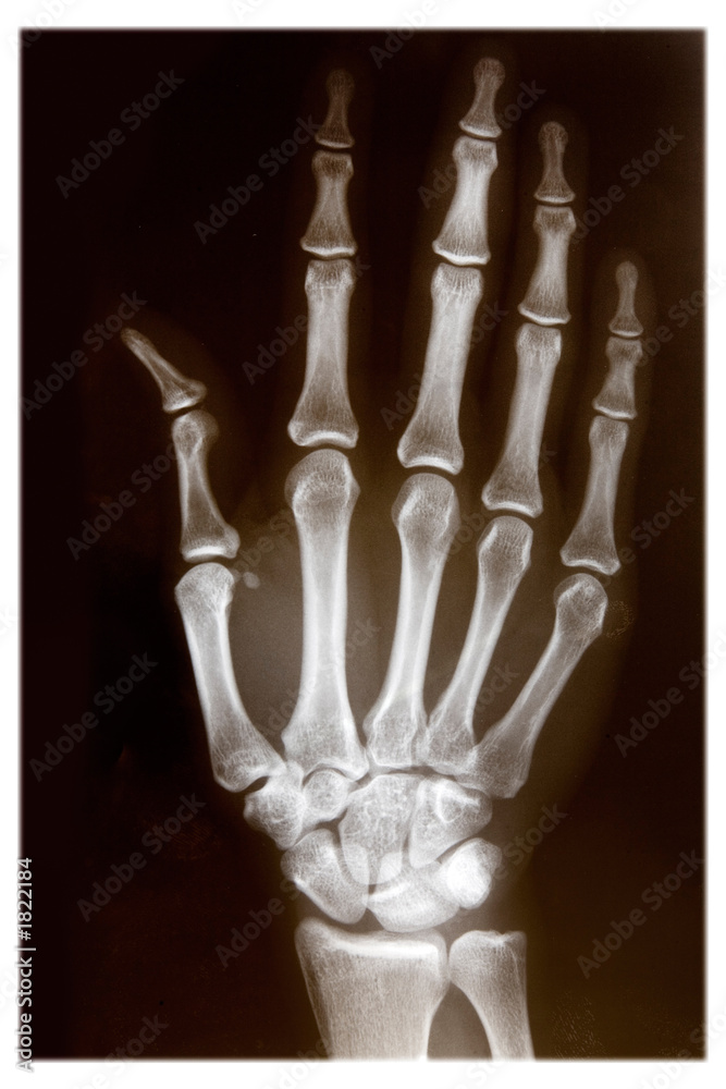 x-ray of hand x-ray of hand