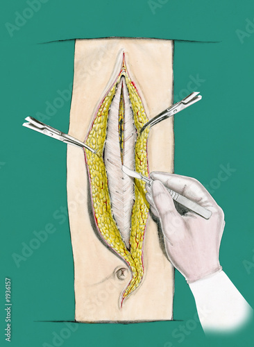 incisione chirurgica