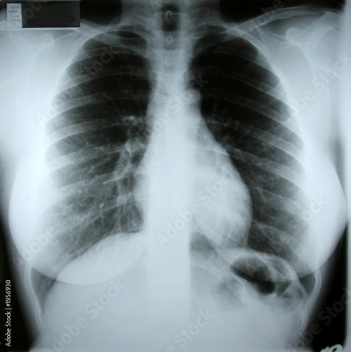 torax xray
