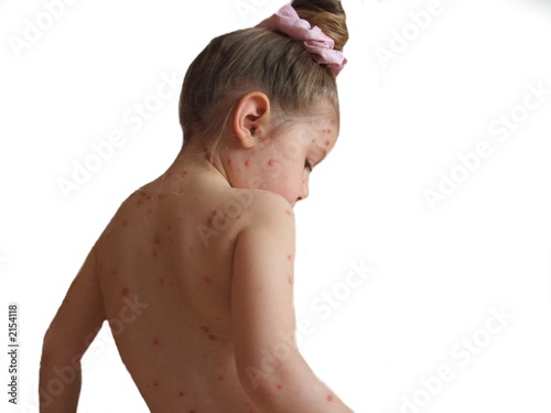 varicella
