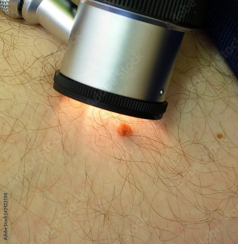 skin cancer checkup photo