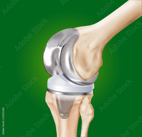 protesi ginocchio con ossa photo