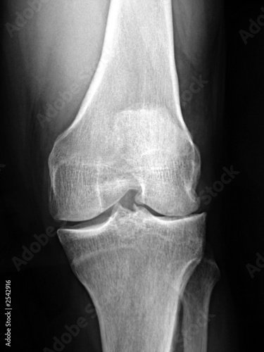 Billede på lærred arthrose femorau tibial externe genou