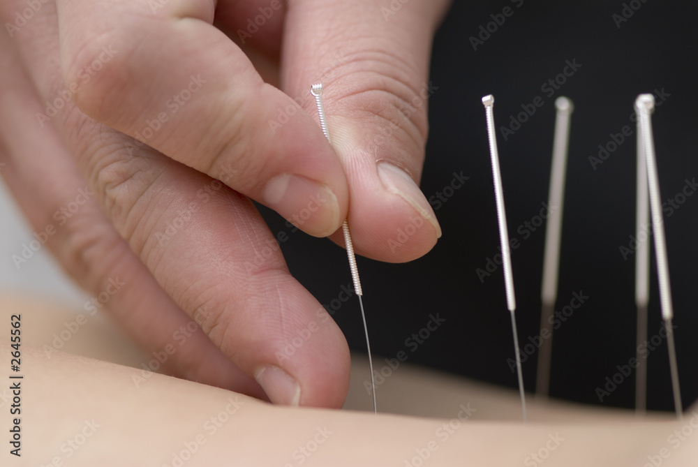 treatment by acupuncture treatment by acupuncture