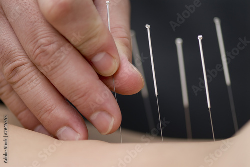 treatment by acupuncture