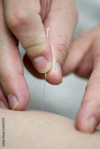 treatment by acupuncture