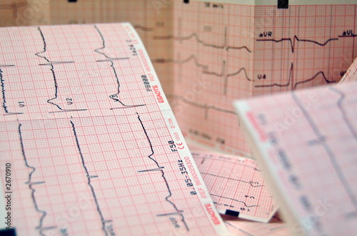 ecg