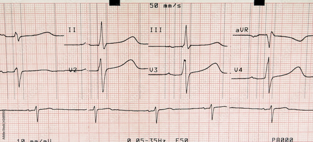 ecg ecg