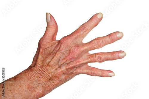 arthritis hand