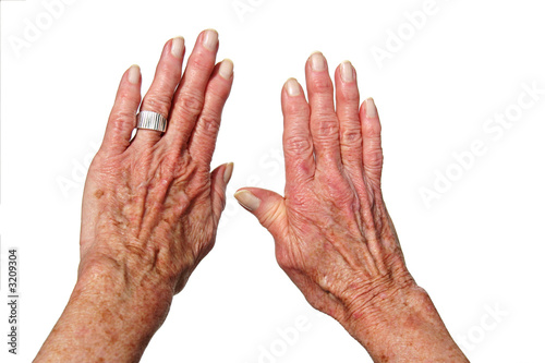 arthritis hands