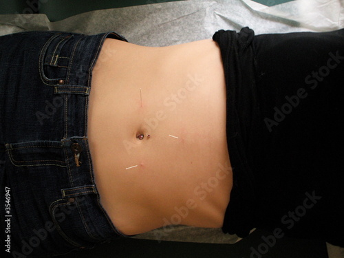 Needles in Stomach During Acupuncture Appointment