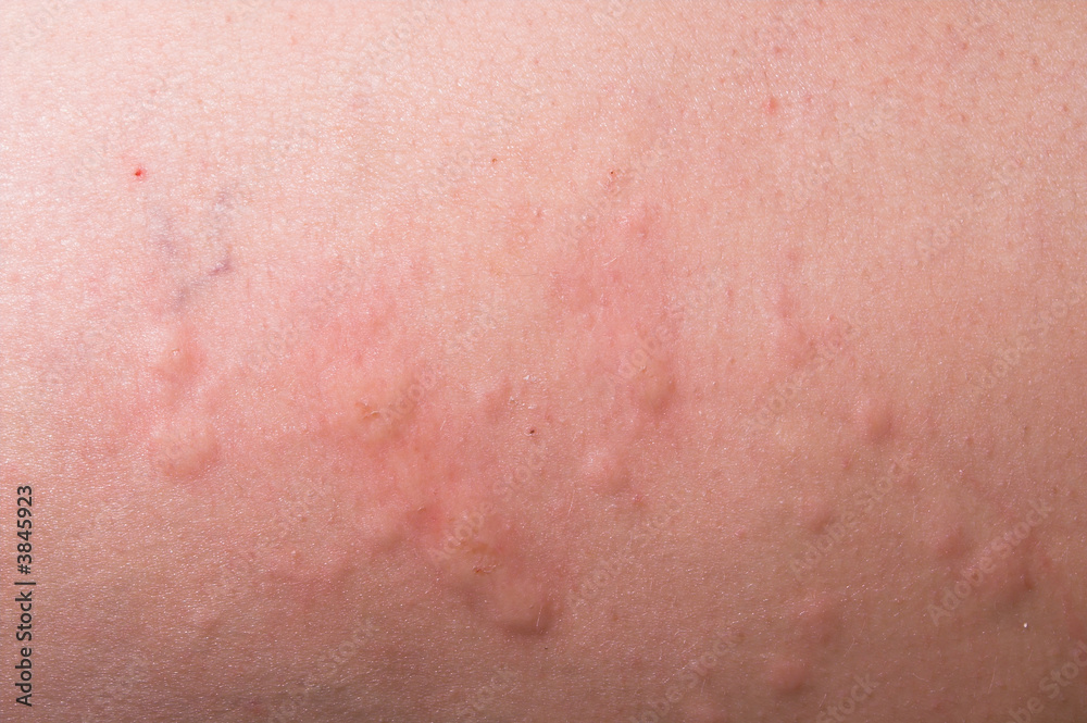 An allergic reaction causeing a severe case of hives.