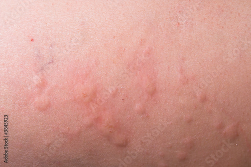 An allergic reaction causeing a severe case of hives.