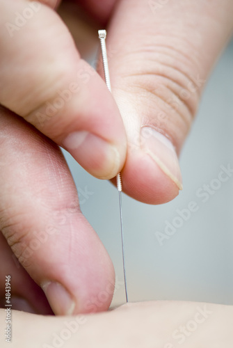 Treatment by acupuncture