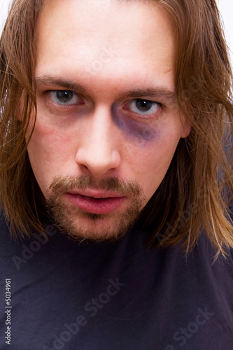 Fotografie Young man with black eye