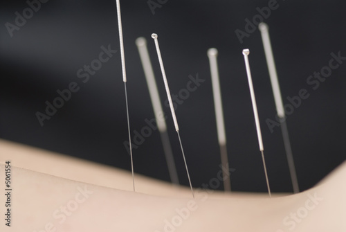 Treatment by acupuncture