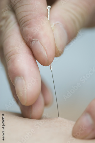 Treatment by acupuncture