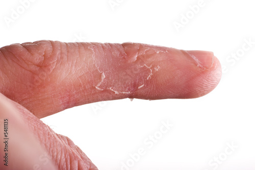 closeup of eczema on male finger with skin peeling