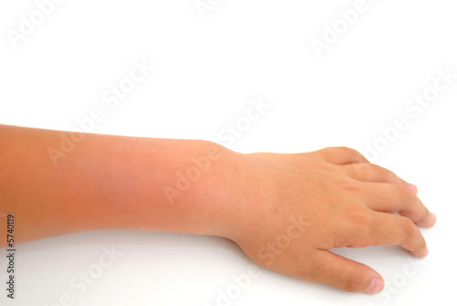 Canvas Print Teen arms swollen after a dislocation